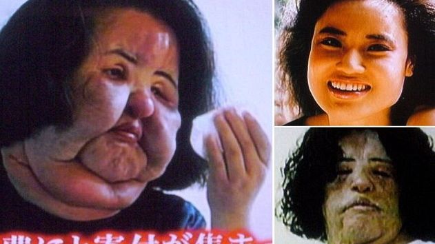 Povestea terifiantă a femeii care şi-a injectat ulei pentru gătit în faţă. Motivul a şocat!