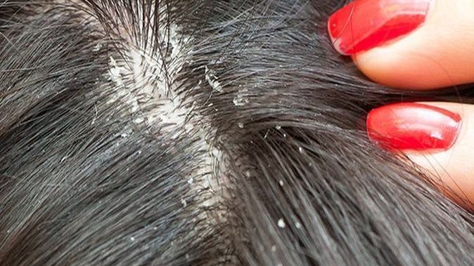 Fetiță trimise acasă de la o grădiniță din Sibiu pe motiv că are păduchi. Șir de acuzații între părinți și directoare