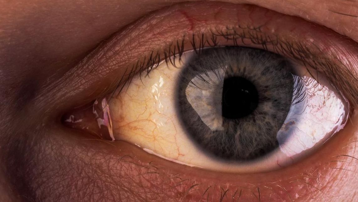 ”Suplimentul alimentar care mi-a distrus ficatul". Drama unui bărbat care a vrut să trăiască sănătos