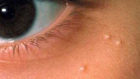 De ce apar punctele de grăsime pe faţă. Când ar trebui să te îngrijorezi