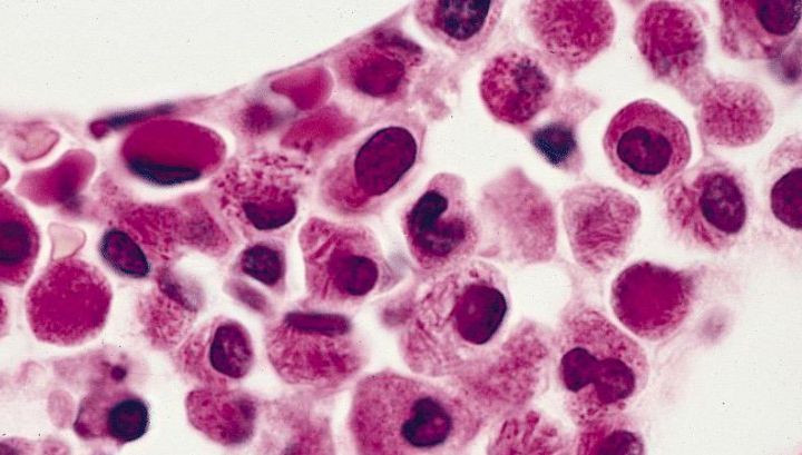 Semne de alarmă care anunță leucemia. Mare atenţie la aceste simptome!