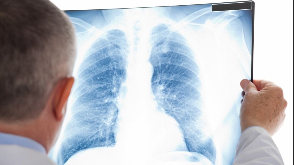Primele simptome ale tuberculozei. Mergi, de urgență, la medic!