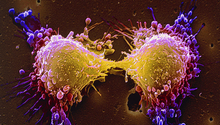 De ce recidivează cancerul după ce "te vindeci"?