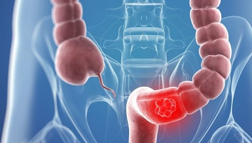 Cancerul de colon: Cauze și simptome