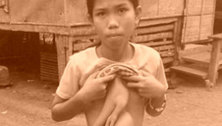 Povestea terifiantă a copilei care a trăit cu trupul fratelui geamăn "lipit" în zona stomacului 