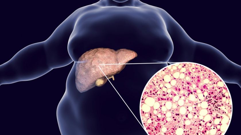 Steatoza hepatică: Cauze și simptome