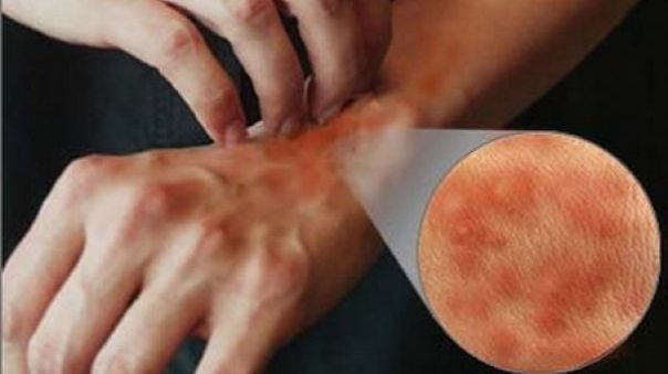 Cât de periculoasă este alergia la penicilină?