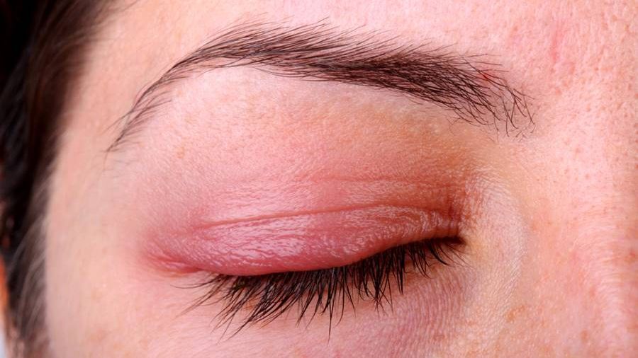 Ce este blefarita? Simptome și cauze