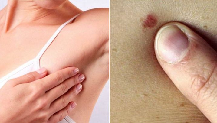 Simptomul care arată clar că ai cancer la sân. Toate femeile îl ignoră!