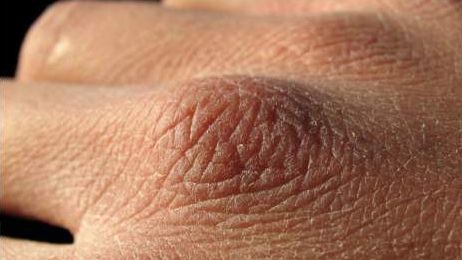 Cancerul apare mai întâi pe mâini. Primele semne care ar trebui să te îngrijoreze