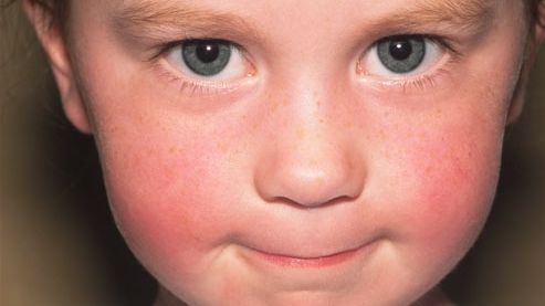 Boala obrajilor pălmuiți sau a cincea boală a copilăriei: Primele simptome