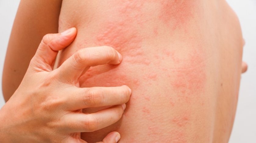 Urticaria acuta. Principalele semne