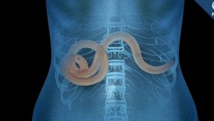 Semne clare că ai paraziți în organism