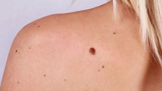 Cel mai agresiv cancer. Metastazează rapid. Cum îl recunoşti