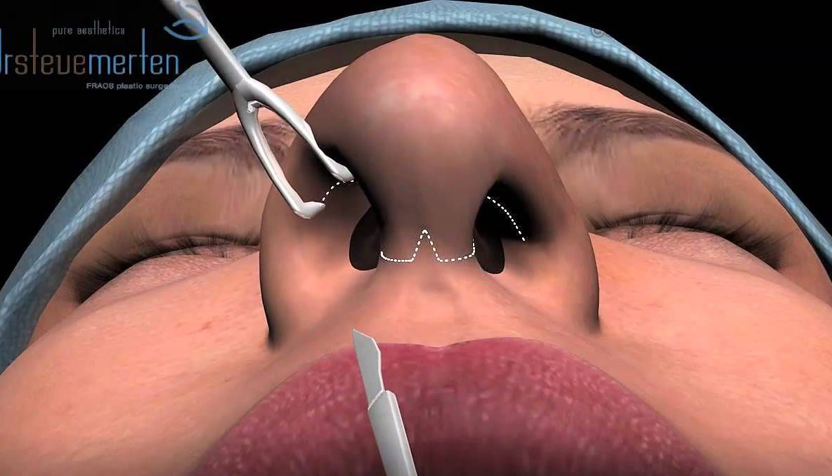 Falsul medic italian învățase cel mai probabil de pe Youtube tehnica operațiilor