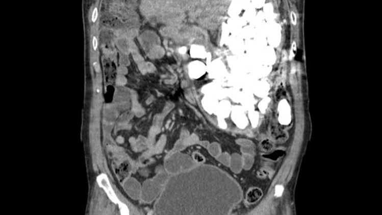 Ce au descoperit medicii în stomacul lui? Le-a mâncat ca să se calmeze