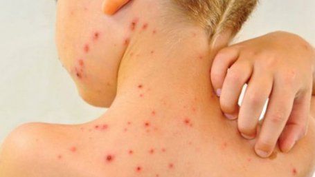 Alertă medicală! Numărul cazurilor de rujeolă este în creștere - Camerele de gardă ale spitalelor de pediatrie, luate cu asalt