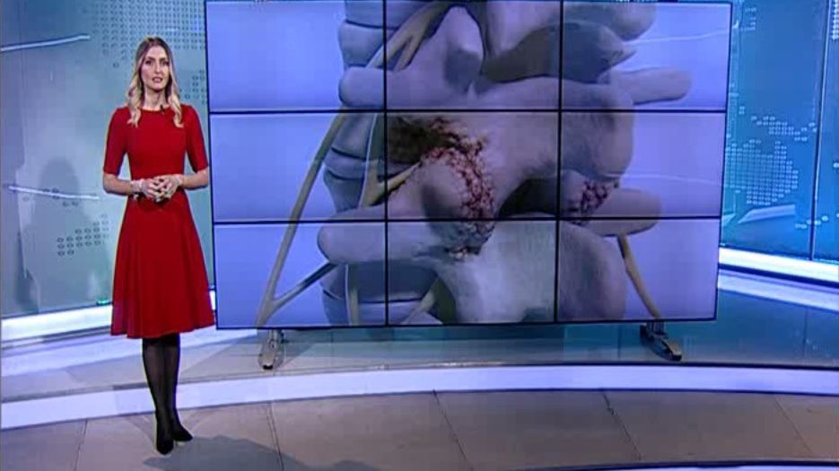 Ce înseamnă hernia de disc de care suferă Liviu Dragnea