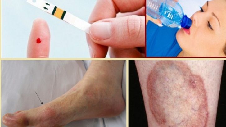 Aşa apare DIABETUL. Patru simptome pe care toată lumea le ignoră