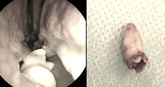 Credea că are nasul înfundat. La operație, s-a dezlănțuit coșmarul! Ce era, de fapt, acolo