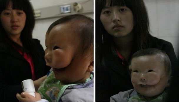 Băiatul cu mască, poveste terifiantă. Afecțiunea care i-a îngrozit până și pe medici!