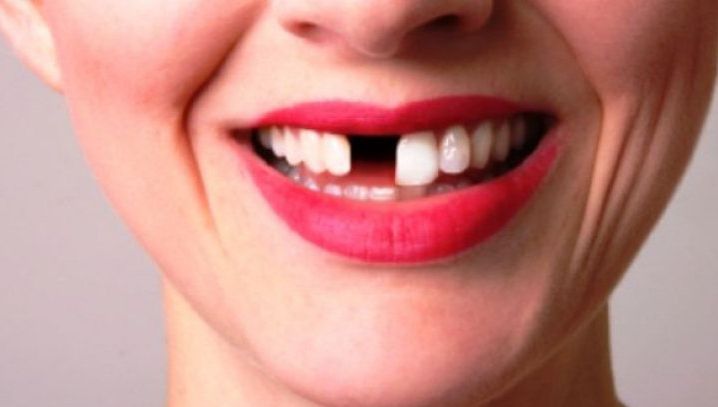 Ce înseamnă când visezi că îţi cad dinţii