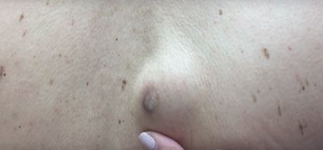 Avea un chist pe spate. S-a operat. Doctorul şi asistentele, aproape de leşin când au văzut ce iese