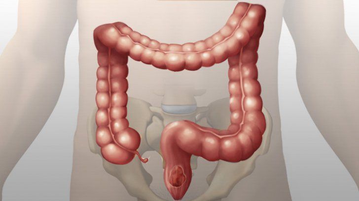 Semne clare care arată că aveți colonul plin de toxine