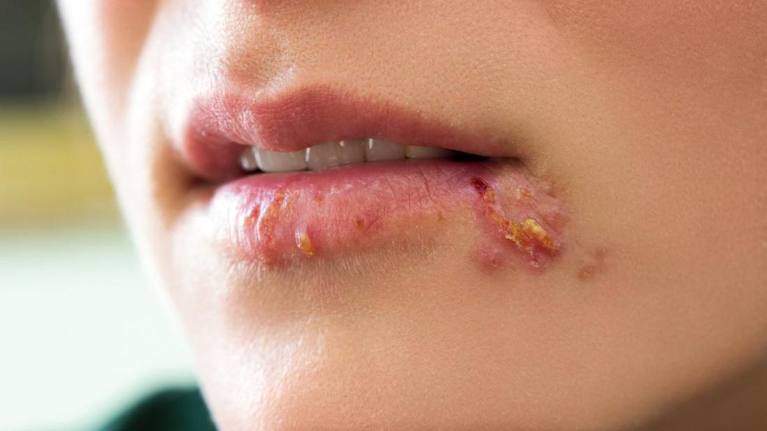 Tratament revoluționar pentru herpes! Fără plasturi, fără medicamente dăunătoare. Cum e posibil?
