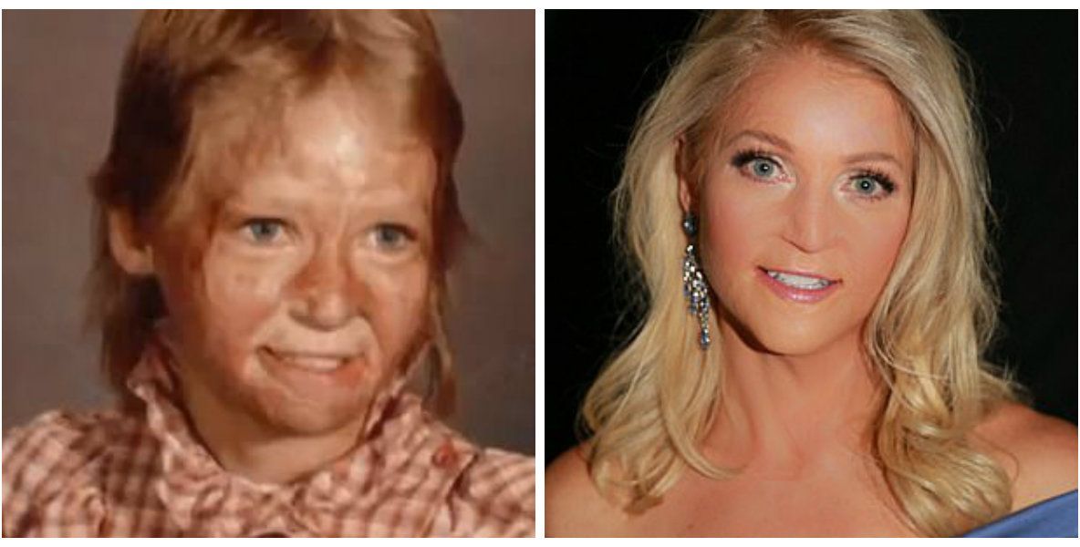 Poveste de viaţă: a suferit arsuri pe 70% din suprafaţa corpului, dar a devenit Miss