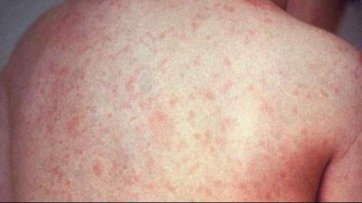 Semnal de alarmă al OMS: Cazurile de rujeolă la nivel mondial au crescut cu 18%