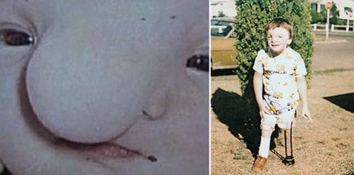 Ce s-a ales de bebelușul care a fost abandonat la naștere pentru că "era prea urât". Cazul a șocat