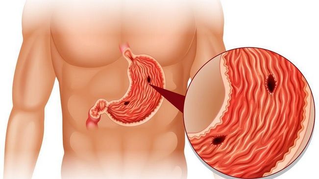 Simptome ale ulcerului care trebuie să te trimită de urgență la medic 