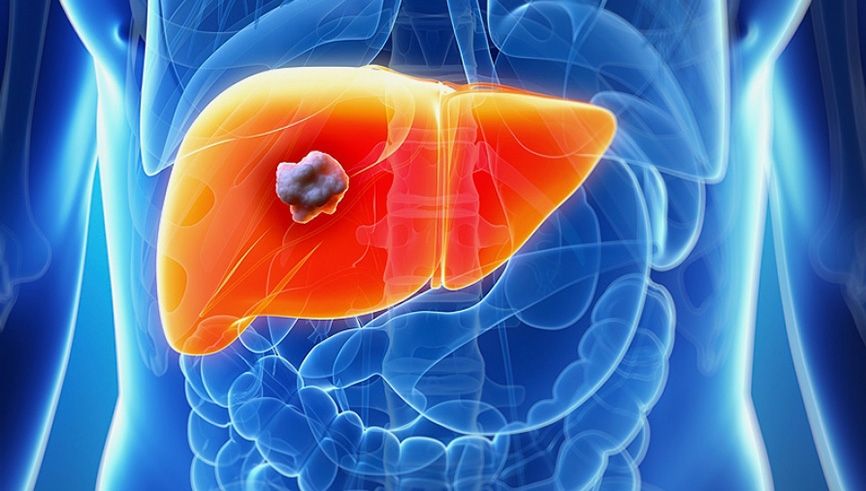 Primele simptome ale cancerului de ficat pe care mulţi le ignoră