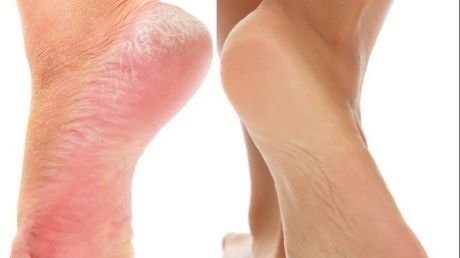 Scapă de călcâiele crăpate cu un ingredient chiar la tine acasă