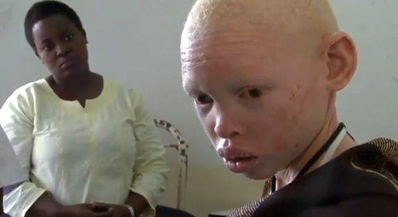 Povestea terifiantă a albinoșilor, talismanele morții: vânați ca animalele și vânduți pe bucăți