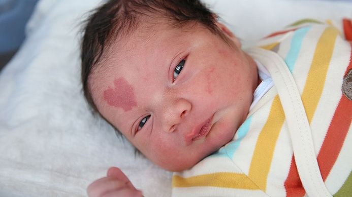 S-a născut cu o inimă pe frunte. La 4 ani, a șocat! Teribil ce s-a întâmplat cu copilul 