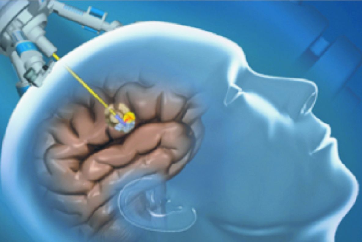 Regula de aur pentru tratarea cu succes a tumorilor cerebrale