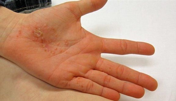 Psoriazis: cauze, simptome și tratament