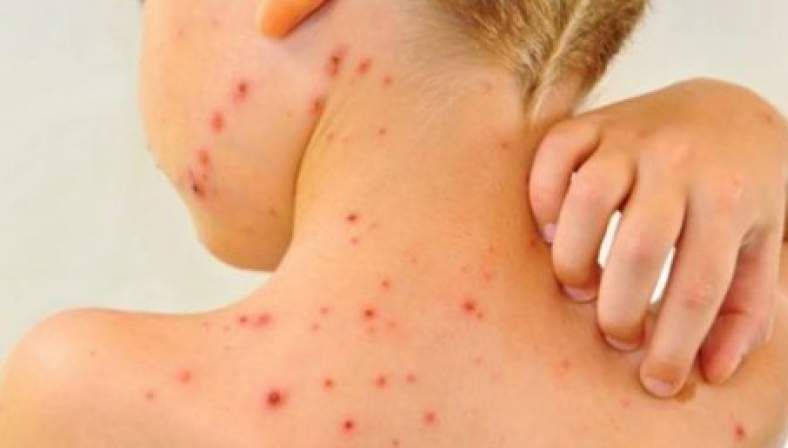 INSP: Încă 11 cazuri noi de rujeolă. Numărul total al infectărilor a ajuns la 201.161