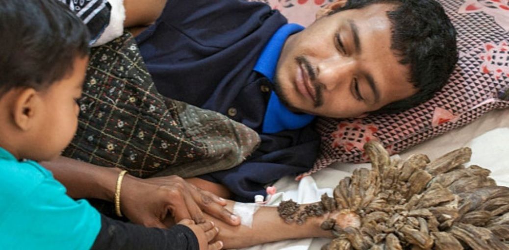 Coșmar pentru omul copac. După operație, i-au dat vestea șoc! Medicii, șocați de ce au găsit