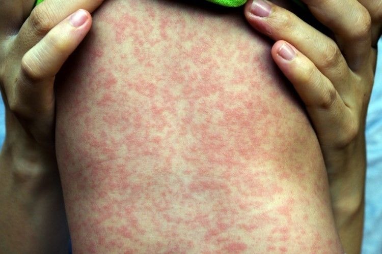 Cea mai mare epidemie din lume. Țara în care POJARUL a ucis aproape 5.000 de oameni  