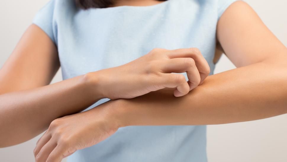 Erupții cutanate, dureri de cap, inflamația mucoasei nazale? Mihaela Bilic explică intoleranța la histamină. Când ar trebui să ne îngrijoreze reacțiile