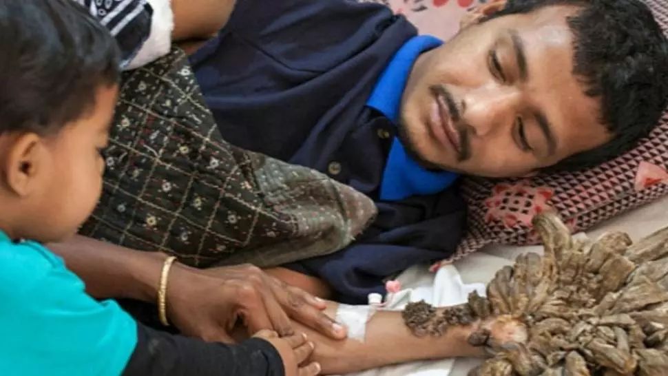 Coșmar pentru omul copac. După operație, i-au dat vestea șoc! Medicii, terifiați de ce au descoperit