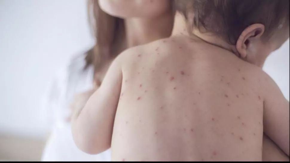 Epidemie de rujeolă, în România. Creștere alarmantă a numărului de cazuri, în doar o săptămână - Virusul s-a extins în 34 de județe și în Capitală - Hartă