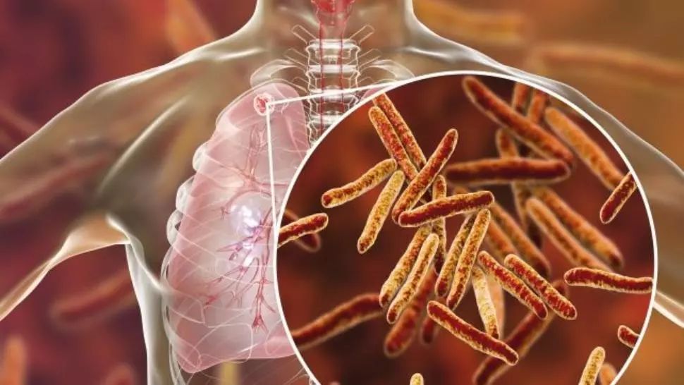 Pacienții cu forme grave de tuberculoză vor beneficia de concediu medical pe toată perioada tratametului