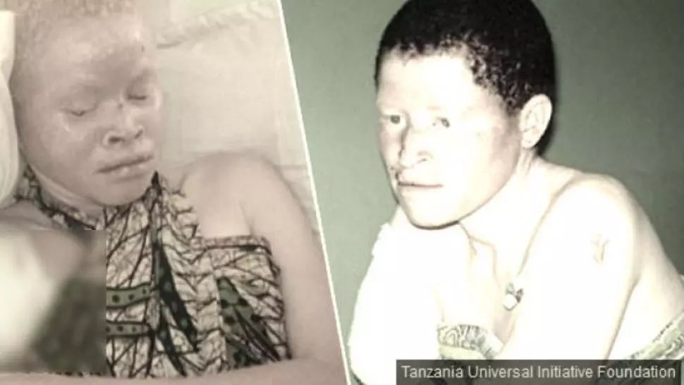 Povestea terifiantă a albinoșilor, talismanele morții: vânați ca animalele și vânduți pe bucăți