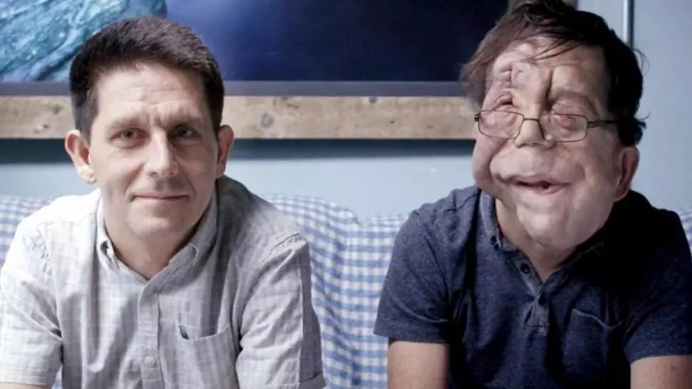 Povestea terifiantă a gemenilor identici care sunt complet diferiți. Au șocat lumea medicală