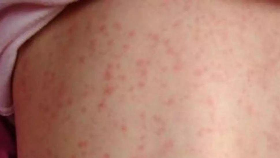 Sălaj, din nou în topul județelor cu cele mai multe cazuri de rujeolă