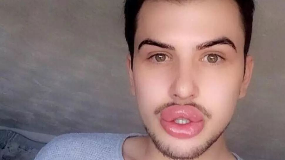 A vrut să fie perfect, dar cum și-a modificat corpul a șocat: până și buzele i-au explodat